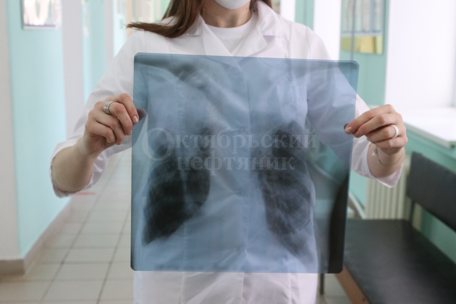 Так выглядят лёгкие человека с туберкулёзом. / Фото: Виктор Лушкин, «Октябрьский нефтяник»