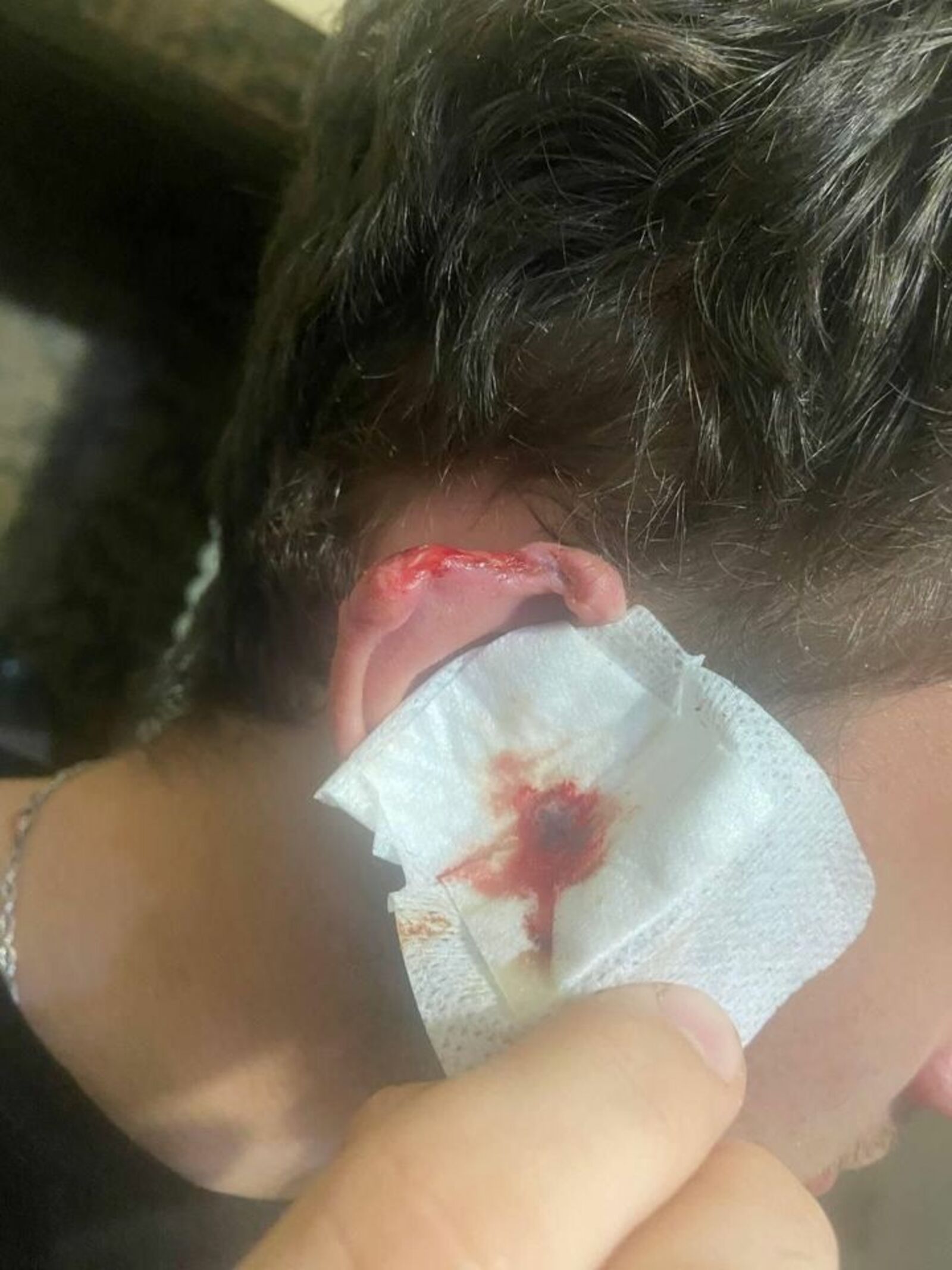 В Октябрьском врачи восстановили ампутированное ухо